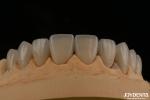 Precise Fit Dental Feldspathic Veneer Highly Natural With Glossy Surface Texture