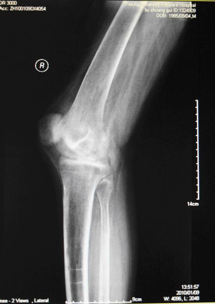 Buy cheap KND-A Low Fog Medical Dry Imaging Film For X Ray Examination On AGFA 5300, 5302, 5500 from wholesalers