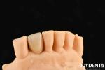 Dental Metal / Maryland Bridege Oral Clinical Repair Metallic Ideal Color