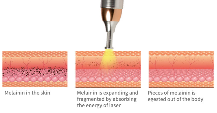 Desktop Q Switch Nd Yag Laser Tattoo Removal Machine Carbon Peeling Facial Skin Rejuvenation