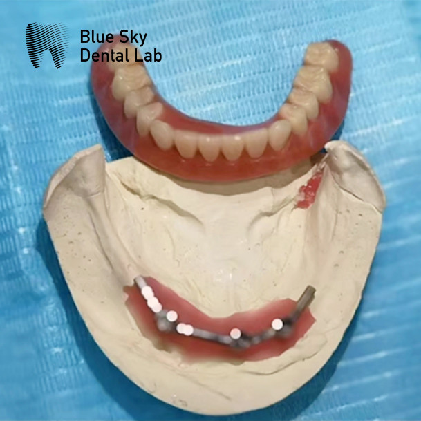 Removable Implant Dental Titanium Bar Segmentation Blue Sky Implant