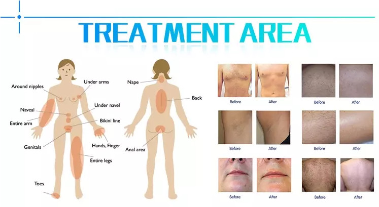 best hair removal 808nm lumenis diode laser hair removal machine