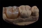 Layered Zirconia Crown for Natural Aesthetics from China Dental Lab
