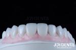 Highly Accurate Dental Restorations Wax Up In Dentistry 1-2mm Thickness
