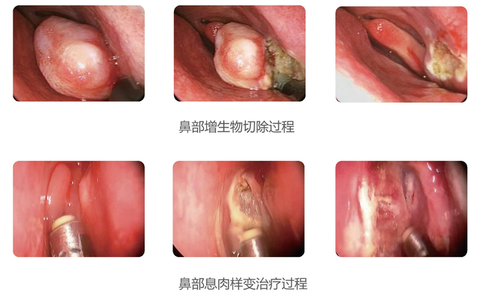 Cryogenic Radio Frequency Plasma Surgery System Minimal Invasive