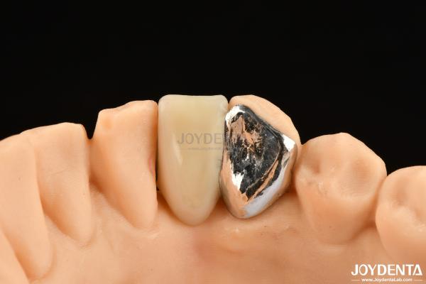 Buy cheap Ideal Matching Clinical Bonding Maryland Dental For Oral Clinical Repair Work from wholesalers