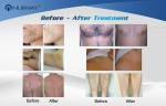 Diode laser hair removal machine / 808nm diode laser hair removal equipment