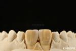 0.2mm Thickness Microthin Veneers Glass Ceramic Dental Veneers For Front Teeth