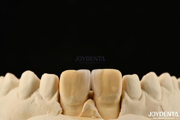 Buy cheap 0.2mm Thickness Microthin Veneers Glass Ceramic Dental Veneers For Front Teeth from wholesalers
