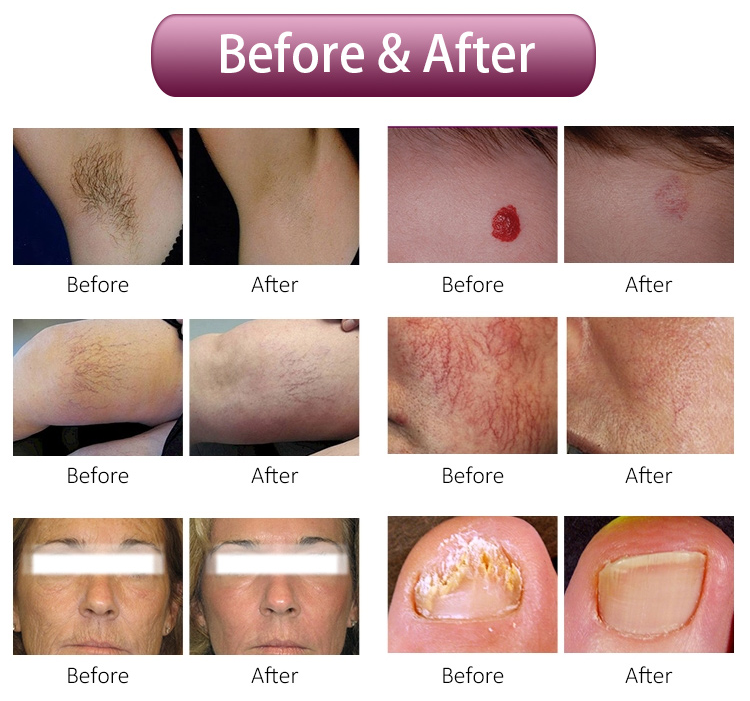 Hair Removal Alexandrite Laser Machine
