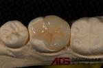 Seamless Porcelain Emax Veneers Teeth Replacement Authentic Looking