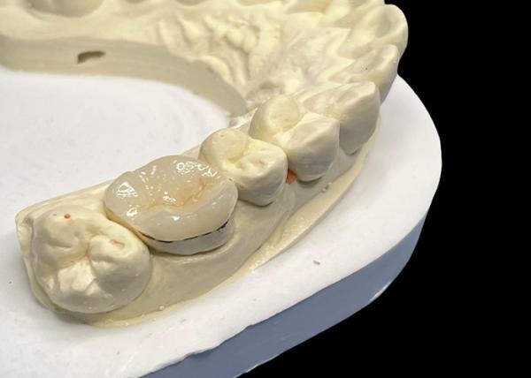 Buy cheap Hypoallergenic Porcelain Inlays Onlays for Teeth Repair Natural Color and Easy Maintenance from wholesalers
