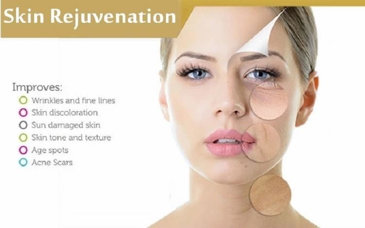2 Handle Nano RF Microneedling Machine Acne Scar Removal Laser Machine