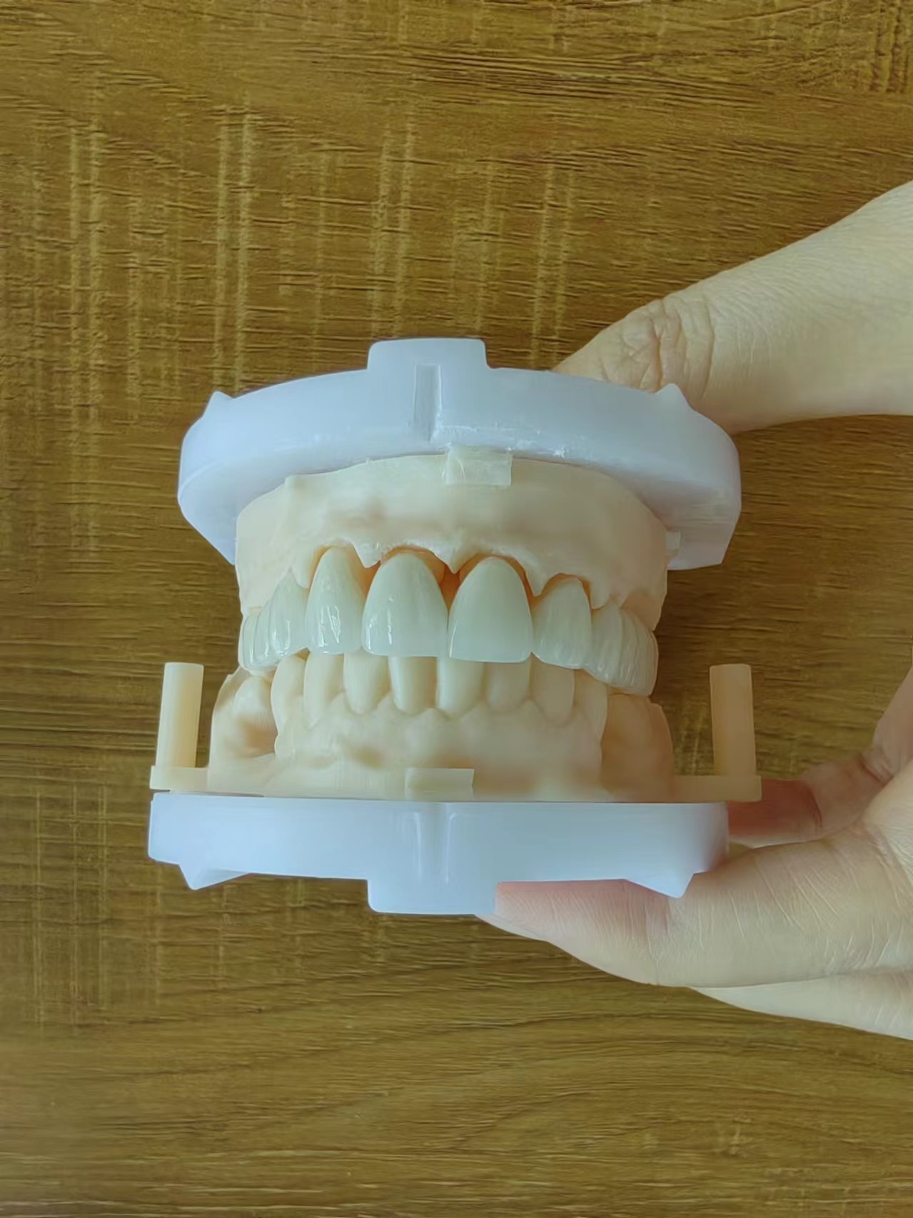 Layered Zirconia Bridge For Fixed Restoration Beautiful Smiles Professional Stable