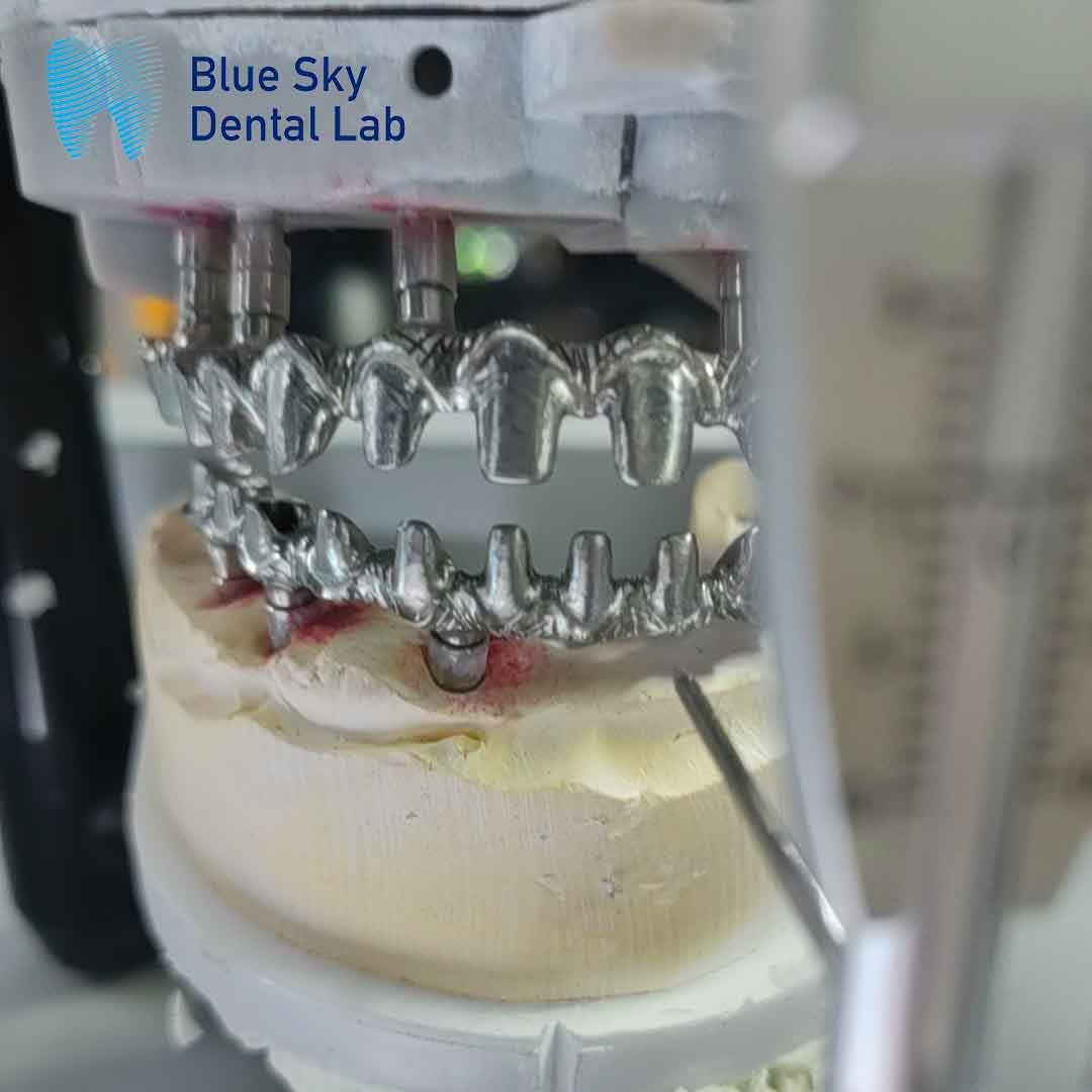Pure Titanium Malo Implant Bridge Universal Metal Frame Malo Bridge