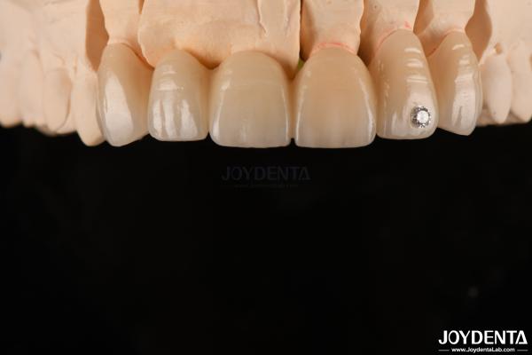 CAD / CAM Milling Dental Layered Zirconia For Single Crowns 0.3-0.5mm Layer