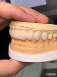 16 Shades Color Emax Dental Veneers A1-A4 High Stain Resistance For Perfectly