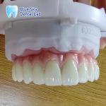 Metal Frame Titanium Malo Bridge Customizable Malo Implant Bridge
