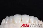 OEM Veneers Dental E-Max Crowns Stain Resistance Minimally Invasive