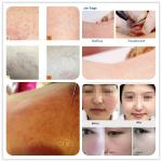 high frequency safety rbs laser spider vein removal machine for wart