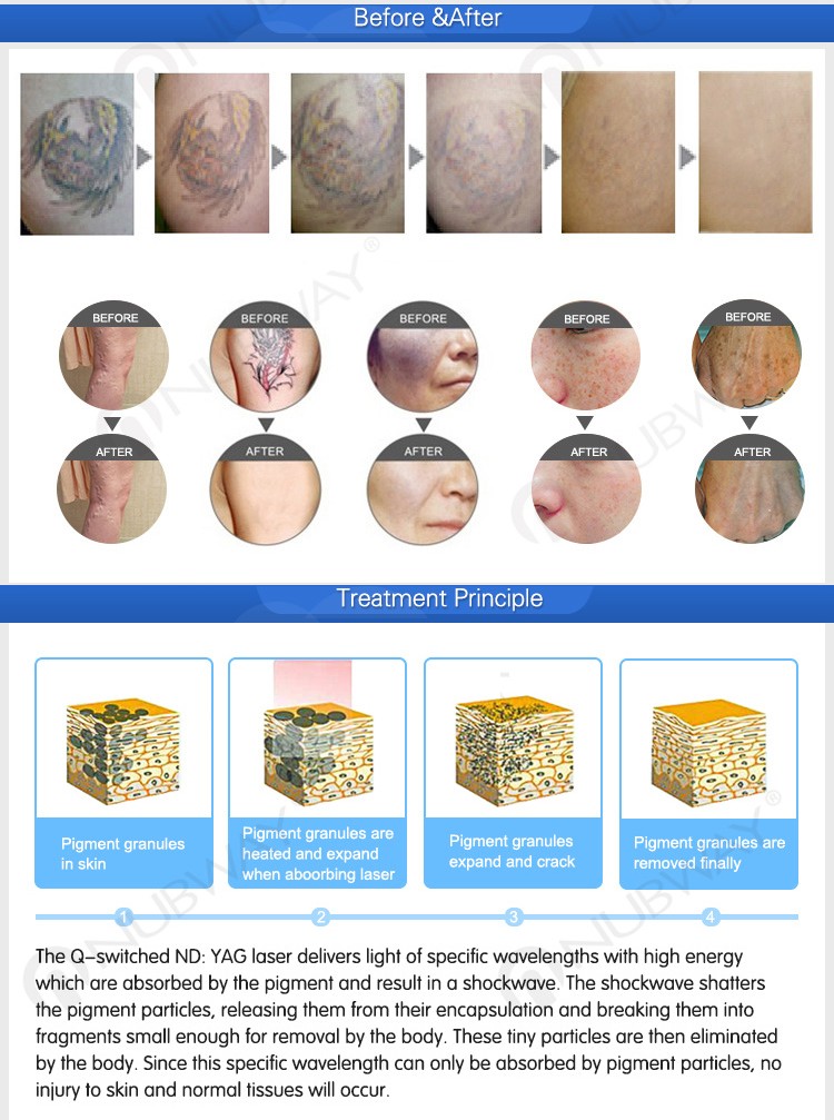 Great demand most advanced q-switched Nd yag laser1064nm & 532nm & 1320nm q-switched nd yag tattoo removal machine