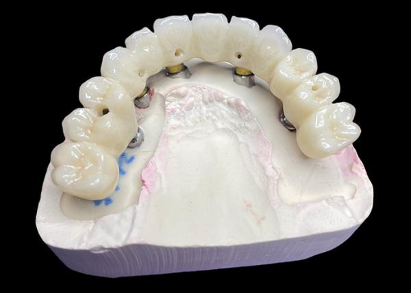 Full Arch Dental Implant Crowns and Bridges Restoring Function and Aesthetics