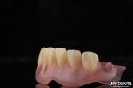 Natural Looking Dental Complete Denture Odor Resistant Adjustable For Proper Fit
