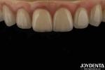 High Translucency Emax Cosmetic Dentistry Veneers High Aesthetics Ultra Thin