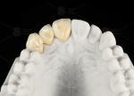 Durable Hypoallergenic EMAX Bridge Extreme Esthetics Emax Dental Bridge