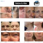 Professional Face Neck Freckle Fractional Plasma Pen with Pigmentation