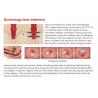 Buy cheap New product ideas 40W medical fractional CO2 laser for Acne removal and scar removal beauty equipment from wholesalers