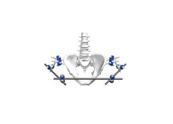 Buy cheap Orthopedic External Fixation External Fixator Pelvic External Fixator from wholesalers