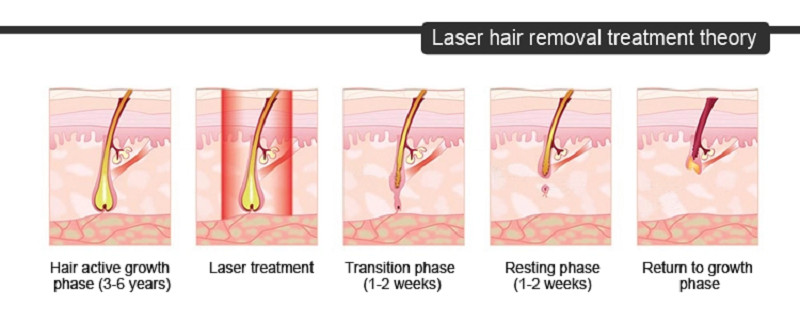 CE 600W 1000W Diode Laser Hair Removal Device Portable
