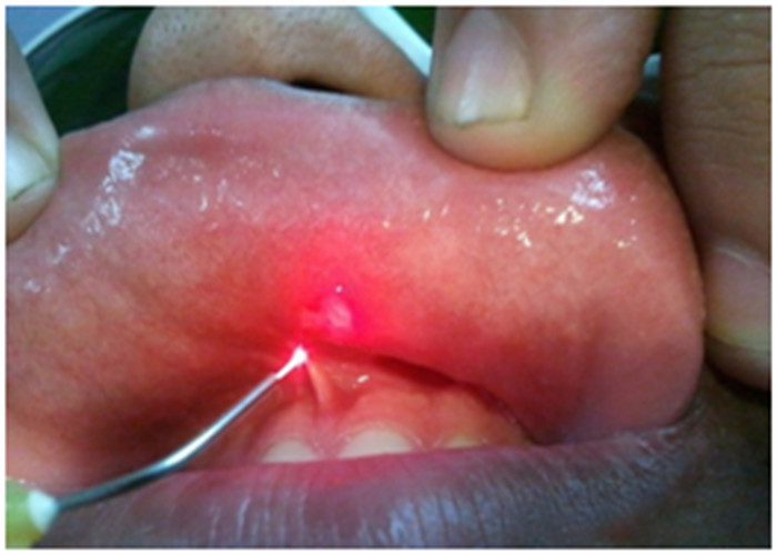 Class IV Soft Tissue Diode Laser Equipment Dental Treatment