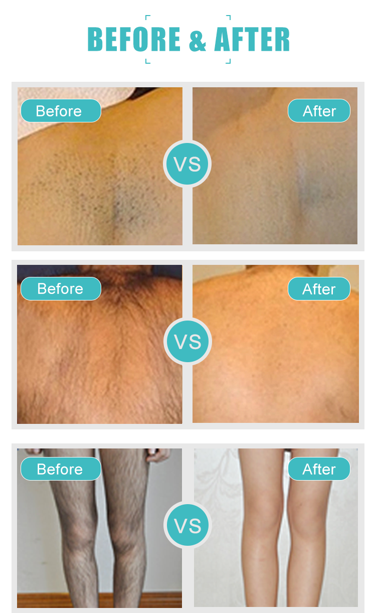 2000W Portable 808 Diode Laser Hair Removal Machine Painless Epilation Device