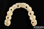 Custom-made Ti-Bar Zirconia Hybrid Bridge The Perfect Combination For Comfort