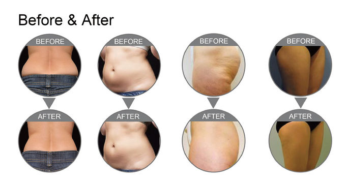 3000W Lipo Laser Slimming Machine