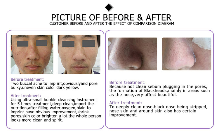 hydrafacial 6in1 h2o2 oxygen jet machine portable peel dermabrasion mask machine facial hydro