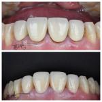 Comfortable Zirconia Dental Bridges Lightweight Natural Color Transitions For