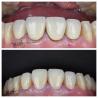 Buy cheap Comfortable Zirconia Dental Bridges Lightweight Natural Color Transitions For Optimal Patient Experience from wholesalers