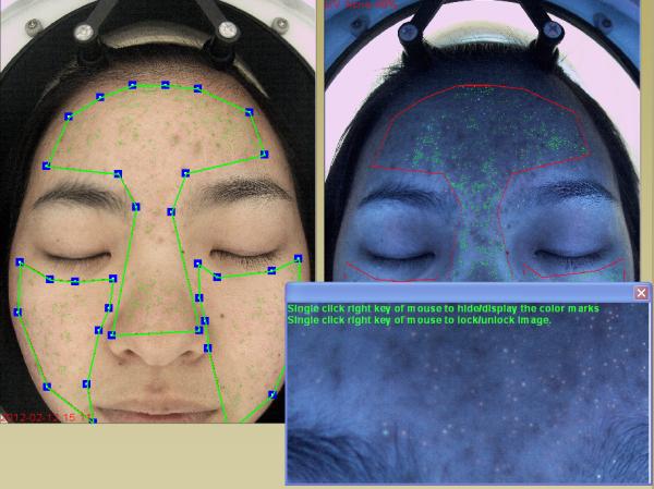 Buy cheap Medical Portable Skin Analyzer Therapist Dermis Layer 10 Years Experience from wholesalers