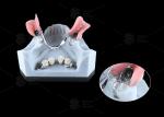 0.1mm Tolerance CEKA REVAX Attachment Titanium 3mm Vertical Clearance