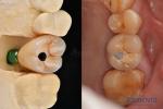 Ultra Hard Colour Stability Dental Implant Crown OEM Easy Maintain Long Lasting