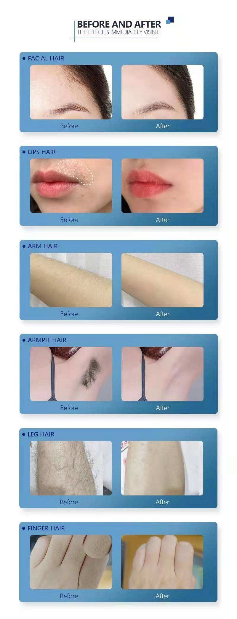 1800W FDA Approved 808 Diode Laser Hair Removal Machine 2in1 Pico