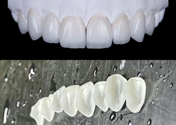 Buy cheap IPS emax Press Porcelain Veneers Achieve a Natural and Radiant Smile from wholesalers
