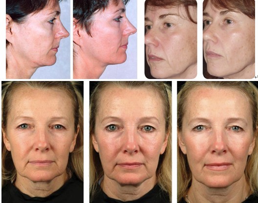 Hot sellingt face lift Thermage machine fractional rf microneedle therapy system