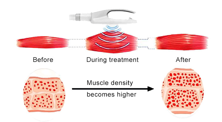 High Intensity Focused Electromagnetic Emslim Fat Burning Machine 3000W