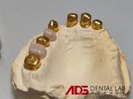 ADS Precision Attachment Dental Telescopic Crowns Mechanism