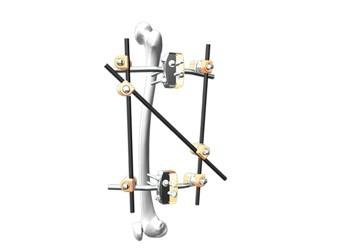 Buy cheap Femur Spanning Orthopedic External Fixator Apply To Fracture Treatment from wholesalers