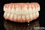 High Durability Ti-Bar Zirconia Hybrid Bridge For Achieving Aesthetics